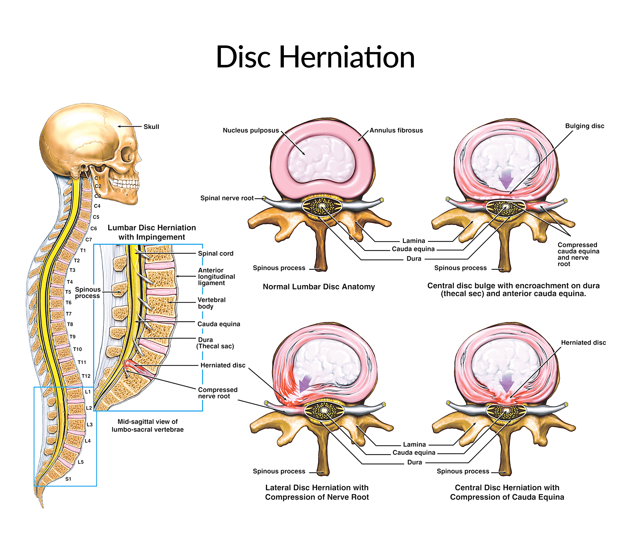 Disc Herniation