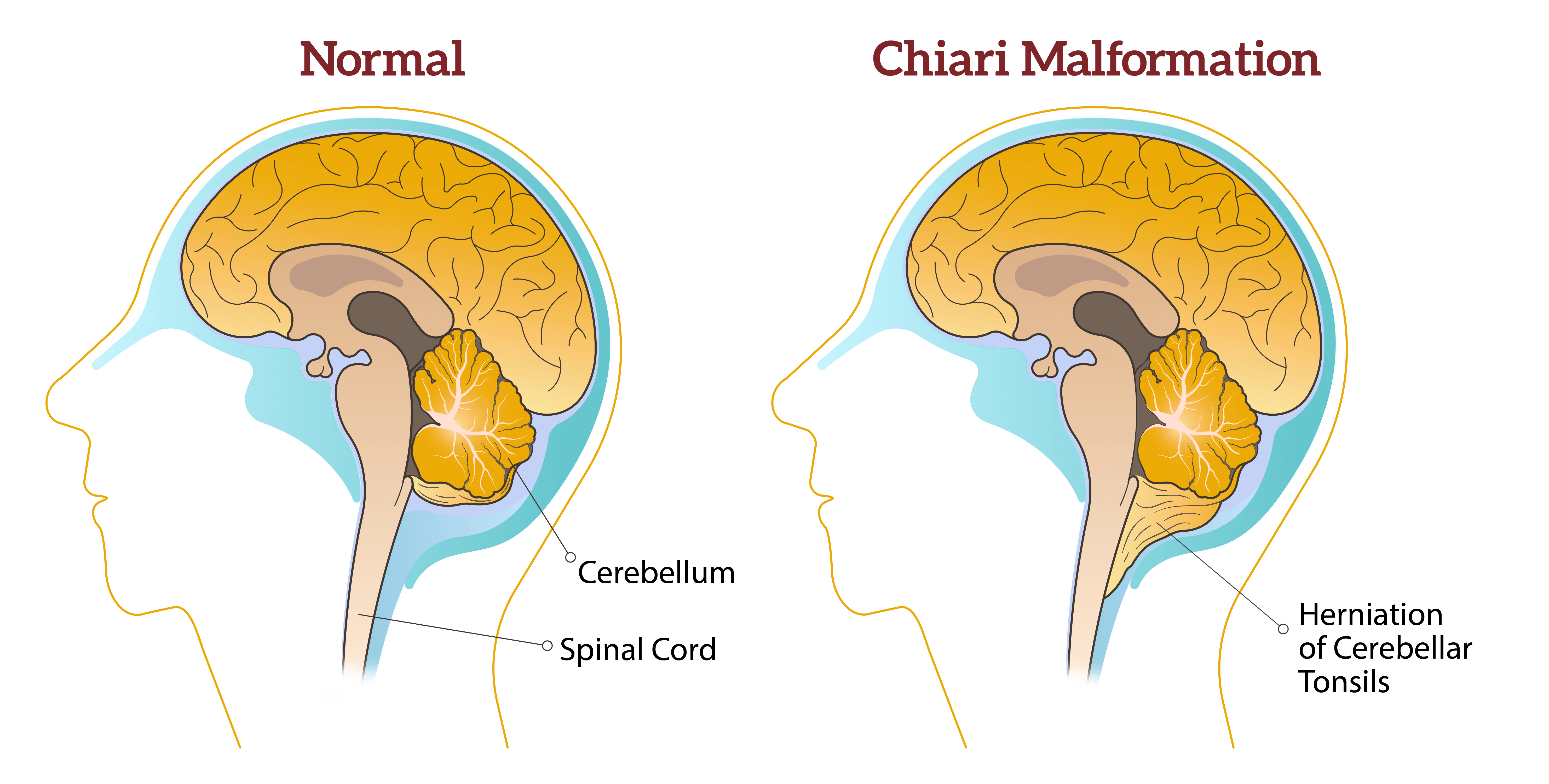 AdobeStock_558728766 Nkrumah Chiari Malformation diagram