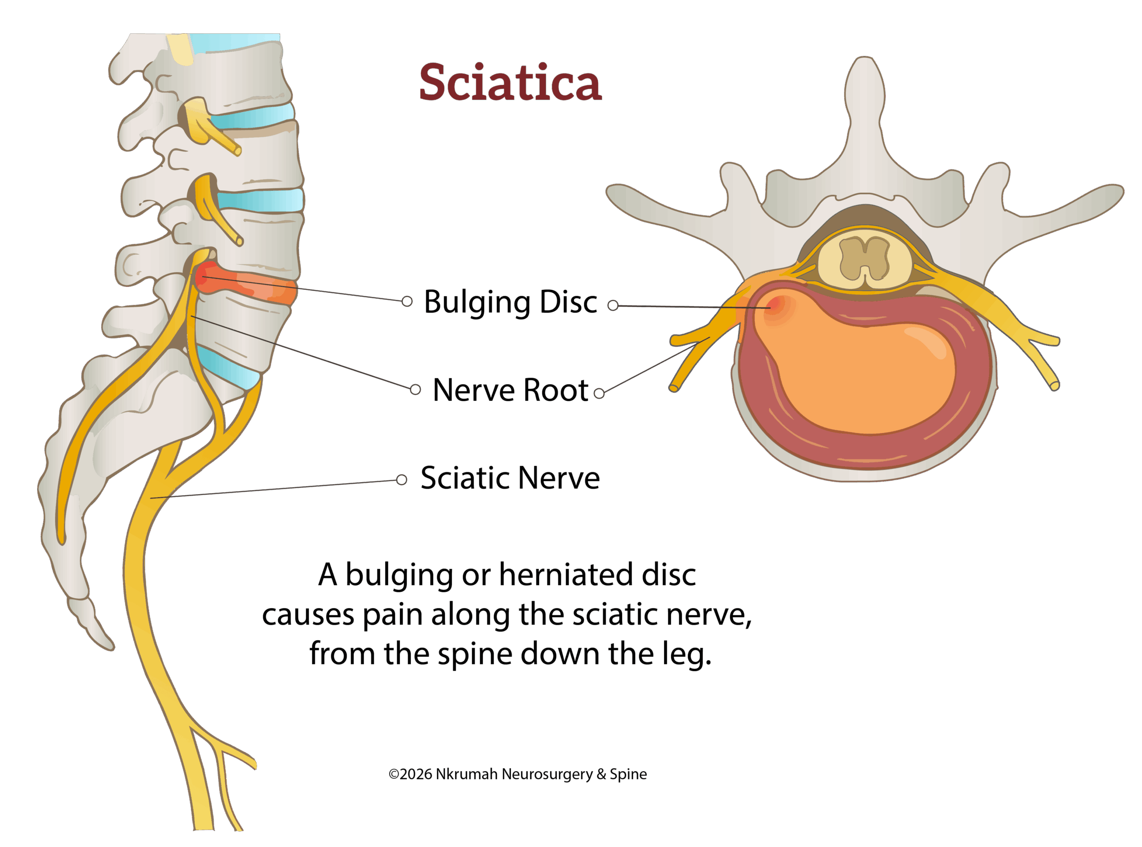 Sciatica (2) sciatica