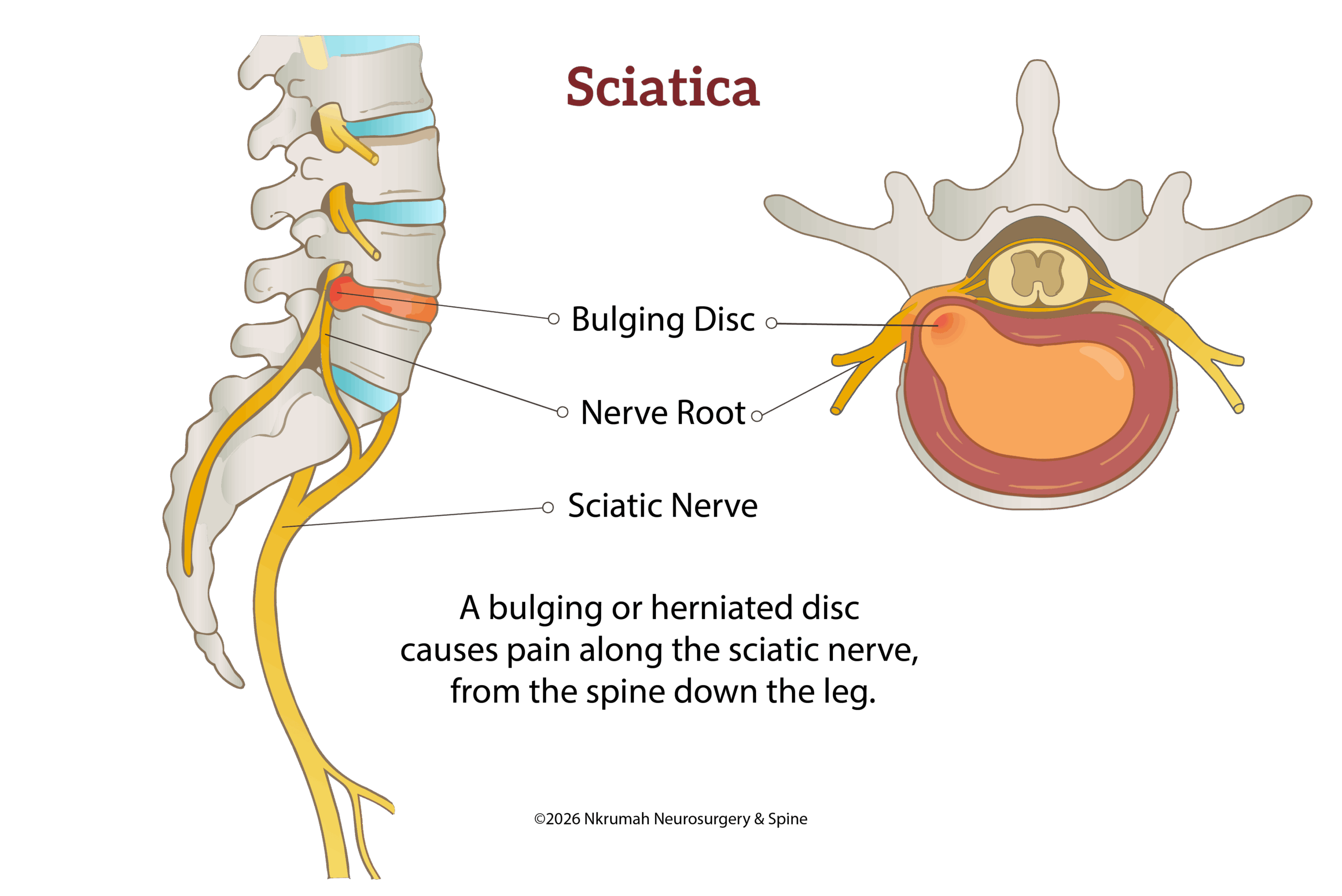 Sciatica - side view and cross section diagrams