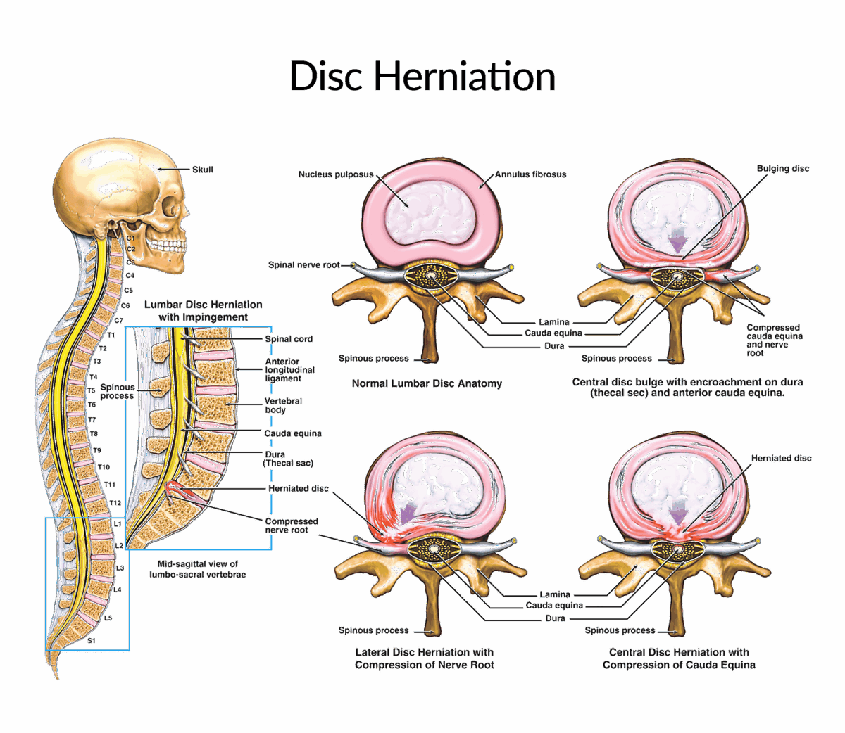 Rare Spinal Disc Herniated Disc Q & A - Nkrumah Neurosurgery