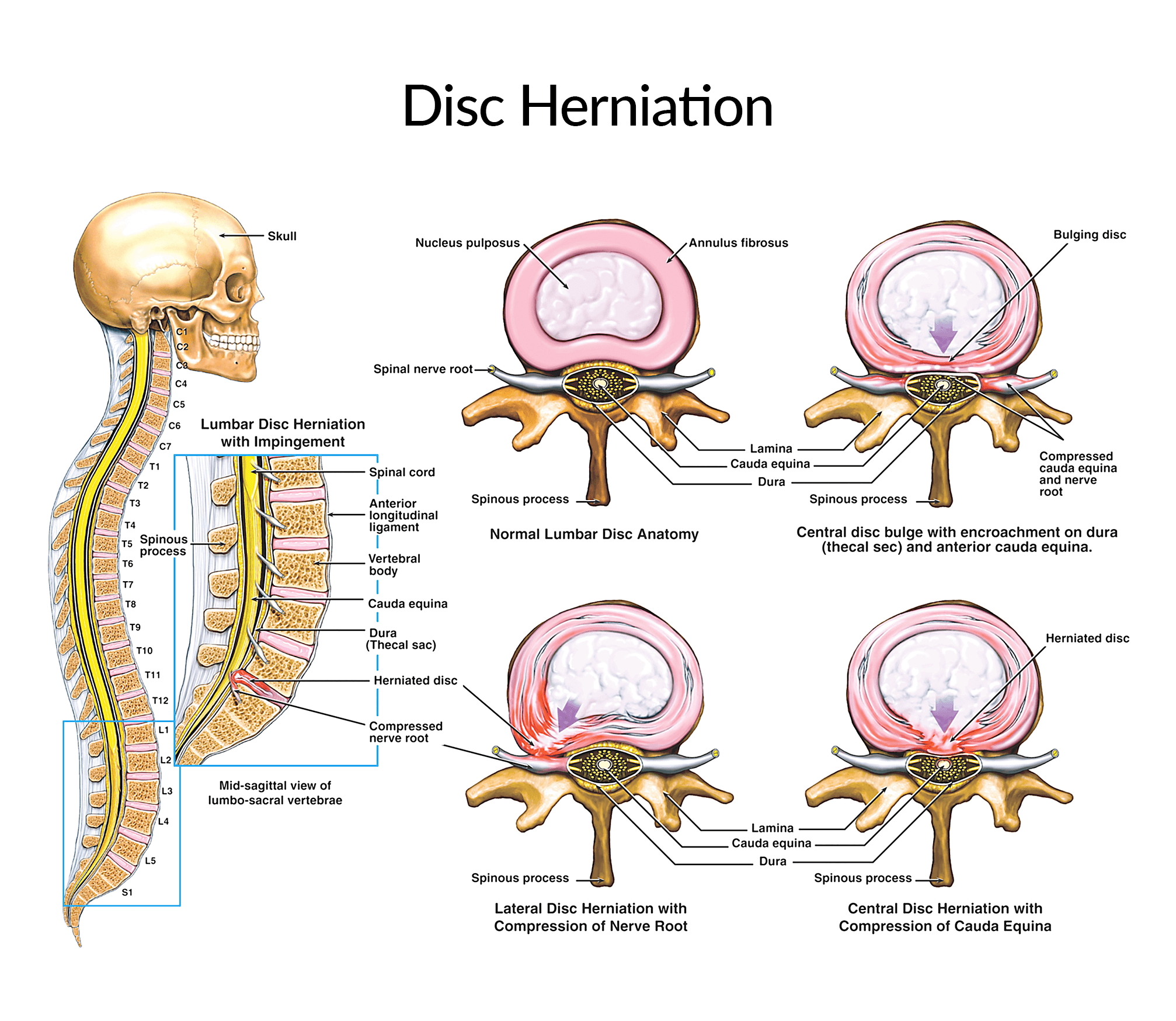 Disc-Herniation copy Disc Herniation