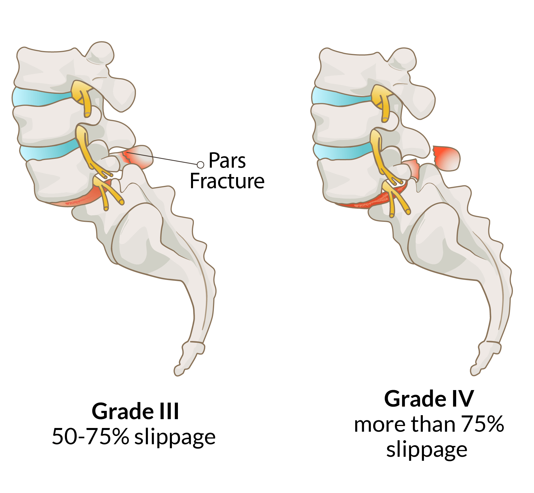 3-Spondoylolisthesis III-IV@2x 3-Spondoylolisthesis III-IV@2x