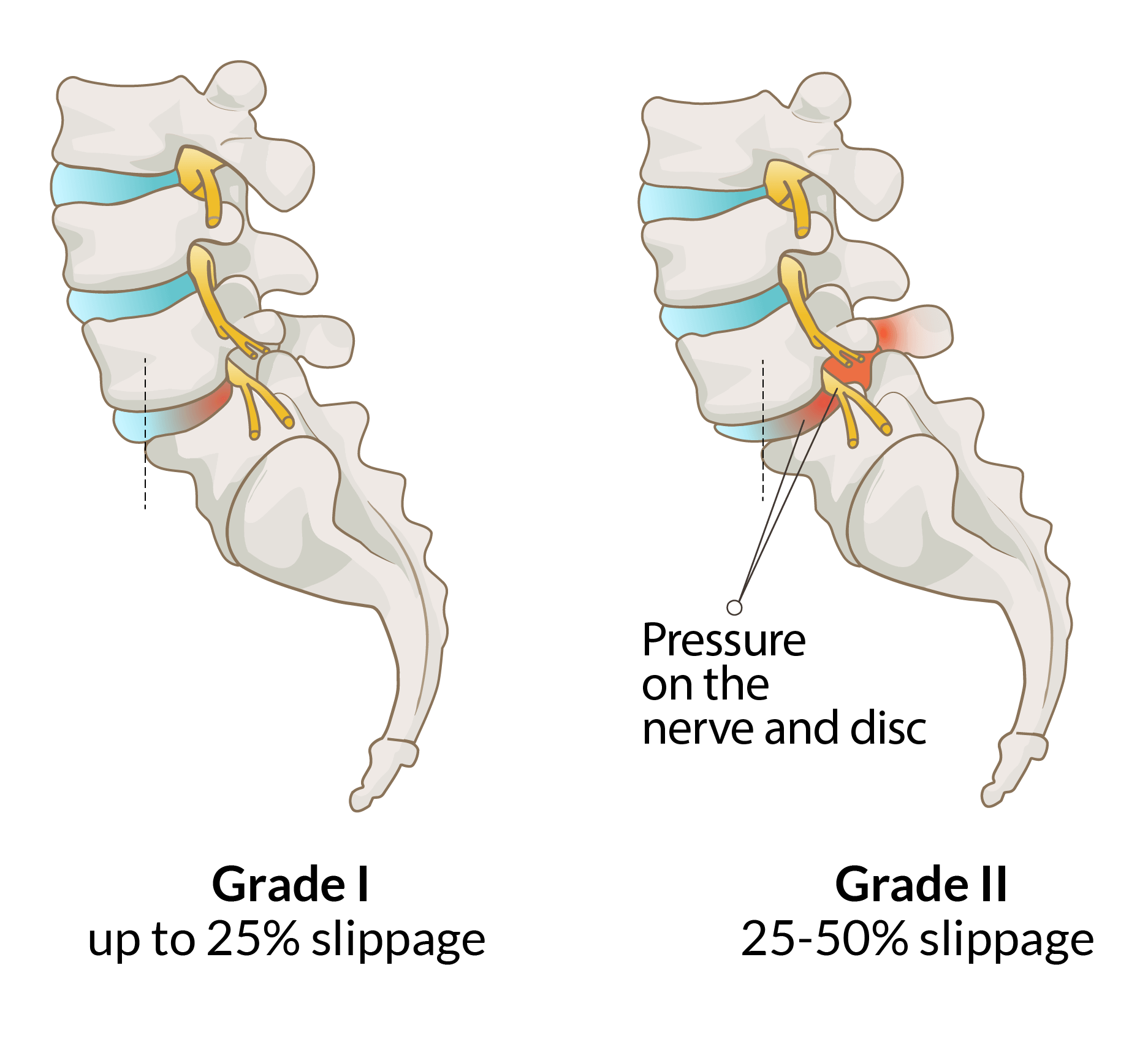2-Spondylolisthesis Grade I and Grade II@2x Spondylolisthesis Grade I and Grade II