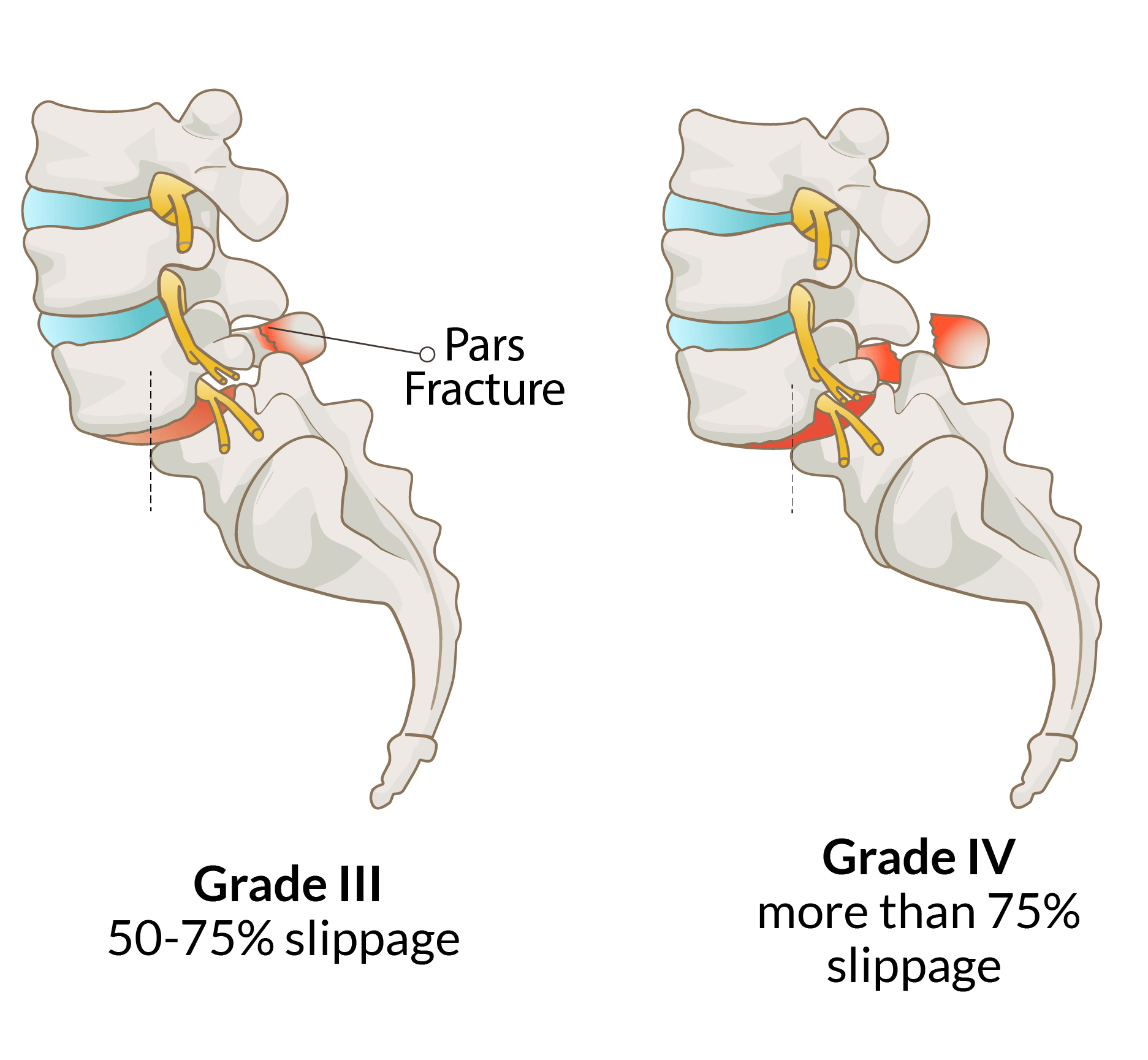 3-Spondylolisthesis Grade III and Grade IV@2x Spondylolisthesis Grade III and Grade IV
